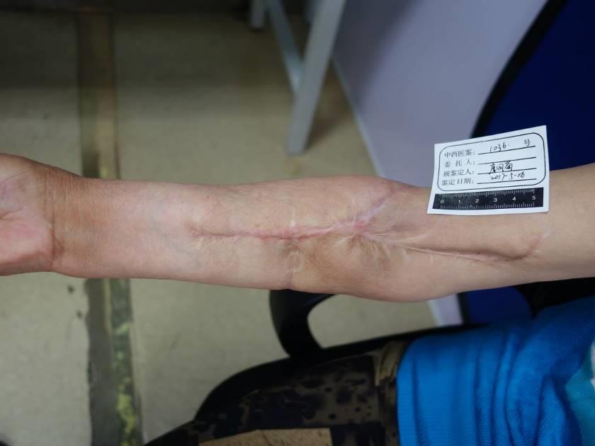 上肢神经损伤致功能缺损法医临床鉴定一例论文