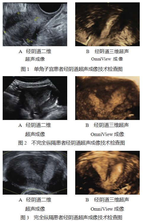 经阴道三维超声自由解剖成像技术在先天性子宫畸形鉴别和分型诊断中的价值分析论文