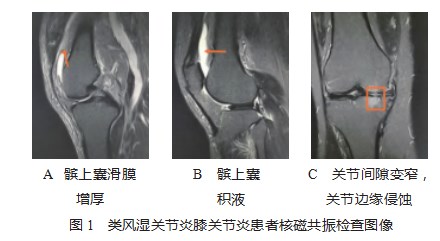 早期类风湿关节炎膝关节炎患者接受核磁共振诊断的价值探讨论文