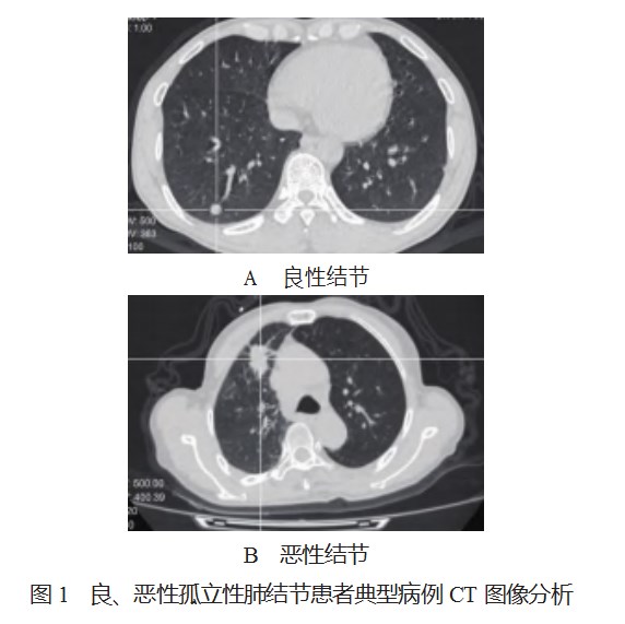 增强CT动态扫描应用于孤立性肺结节鉴别诊断中的价值评价论文
