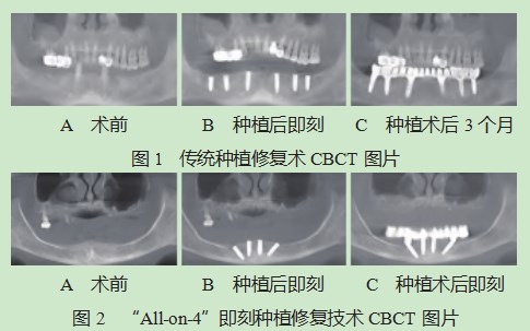 “All-on-4”种植修复技术在牙列缺失患者中的应用及其短期疗效观察论文