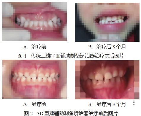 3D重建辅助制备咬合诱导功能矫治器对儿童替牙早期错畸形的治疗效果分析论文