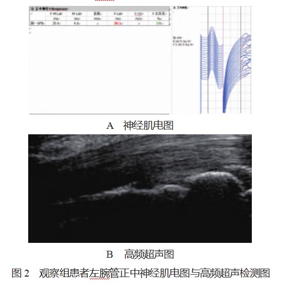 不同程度腕管综合征患者应用高频超声与神经肌电图检查的诊断价值对比论文