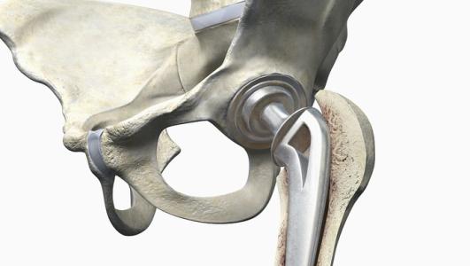 髋关节损伤伤残评定实践分析与思考论文