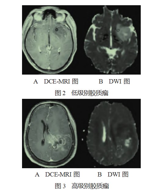多模态磁共振成像对脑星形细胞瘤分级诊断的价值研究论文