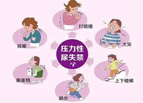 经阴道膀胱颈悬吊治疗女性压力性尿失禁的临床分析论文